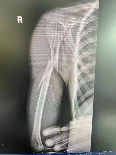 10岁男孩遭遇洗衣机“陷阱”，右臂粉碎性骨折！医生提醒